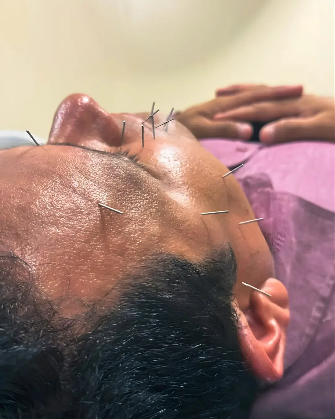 Acupuntura - Sessão de tratamento na Rehabilitare Manaus